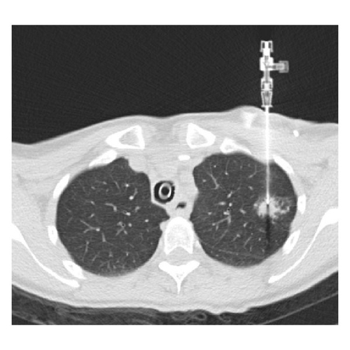 CT image during lung biopsy with guiding needle combined with... | Download  Scientific Diagram